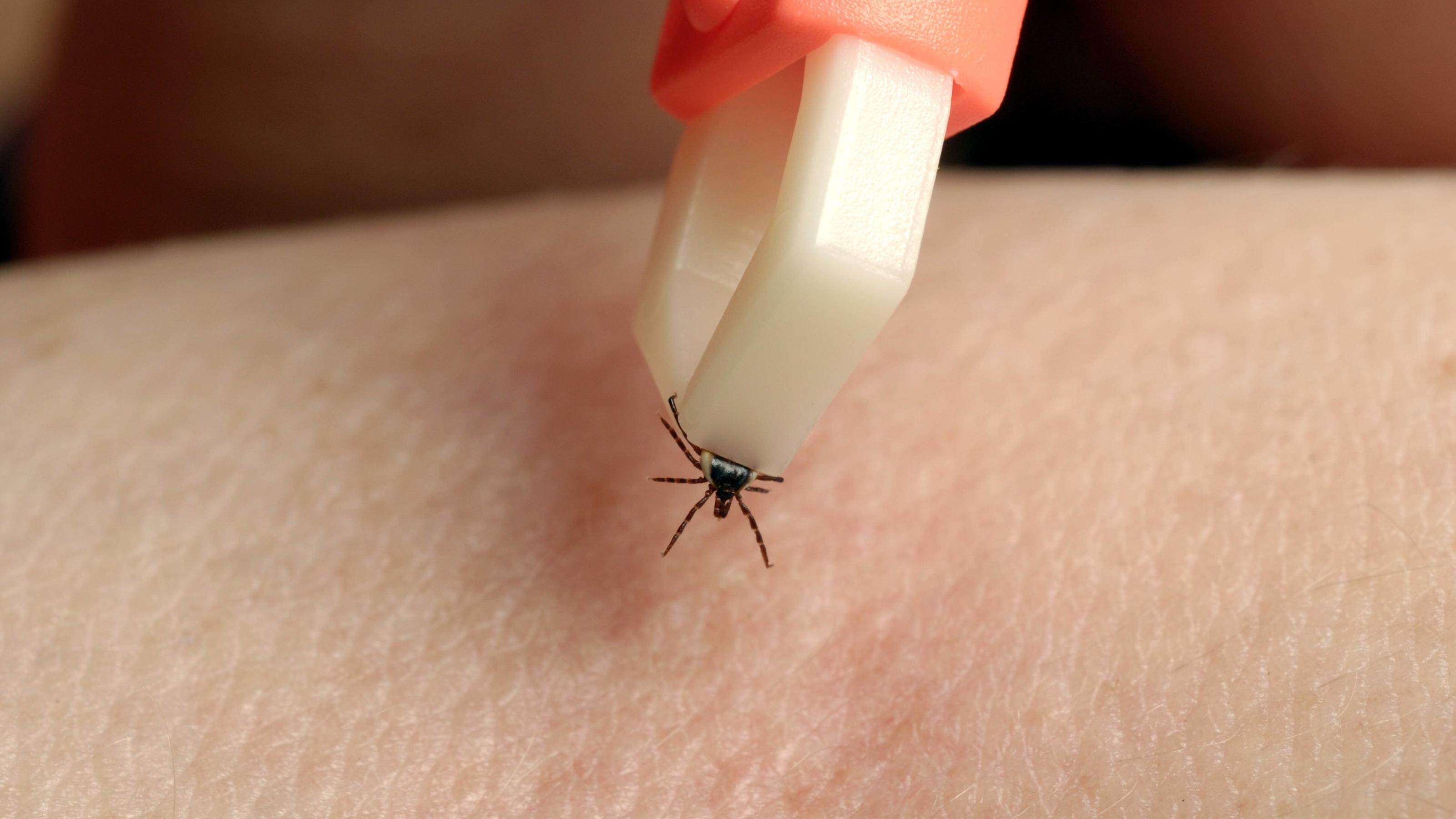 Gefährliche Zeckenbisse: So können Sie sich vor FSME und Borreliose schützen Eine Zeckenzange eignet sich gut, um die kleinen Insekten zu entfernen.