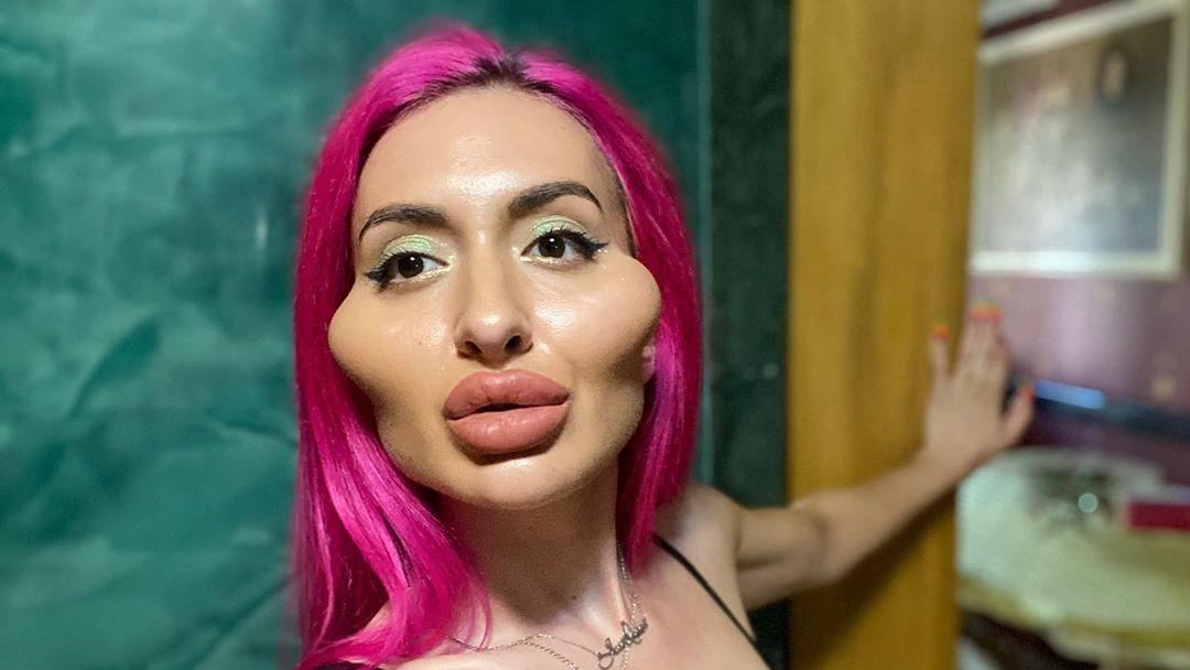 Russische Influencerin schockt mit riesigen Wangen: Die sollen echt sein? Instagram-Model Anastasiia aus Kiew spritzt sich selber Hyaluronsäure unter die Haut.