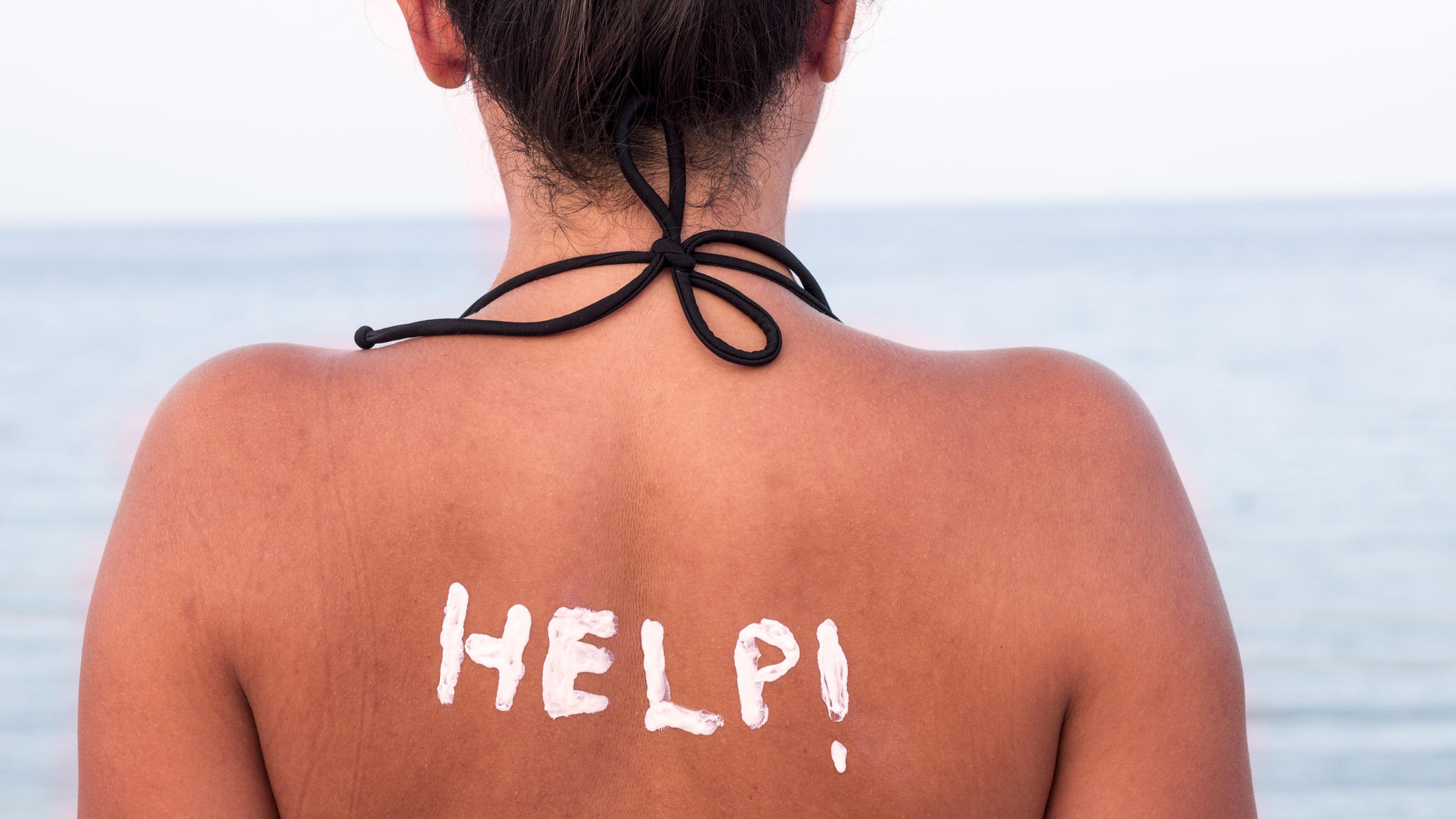 Welche Hausmittel helfen wirklich bei Sonnenbrand? Sonnenbrand