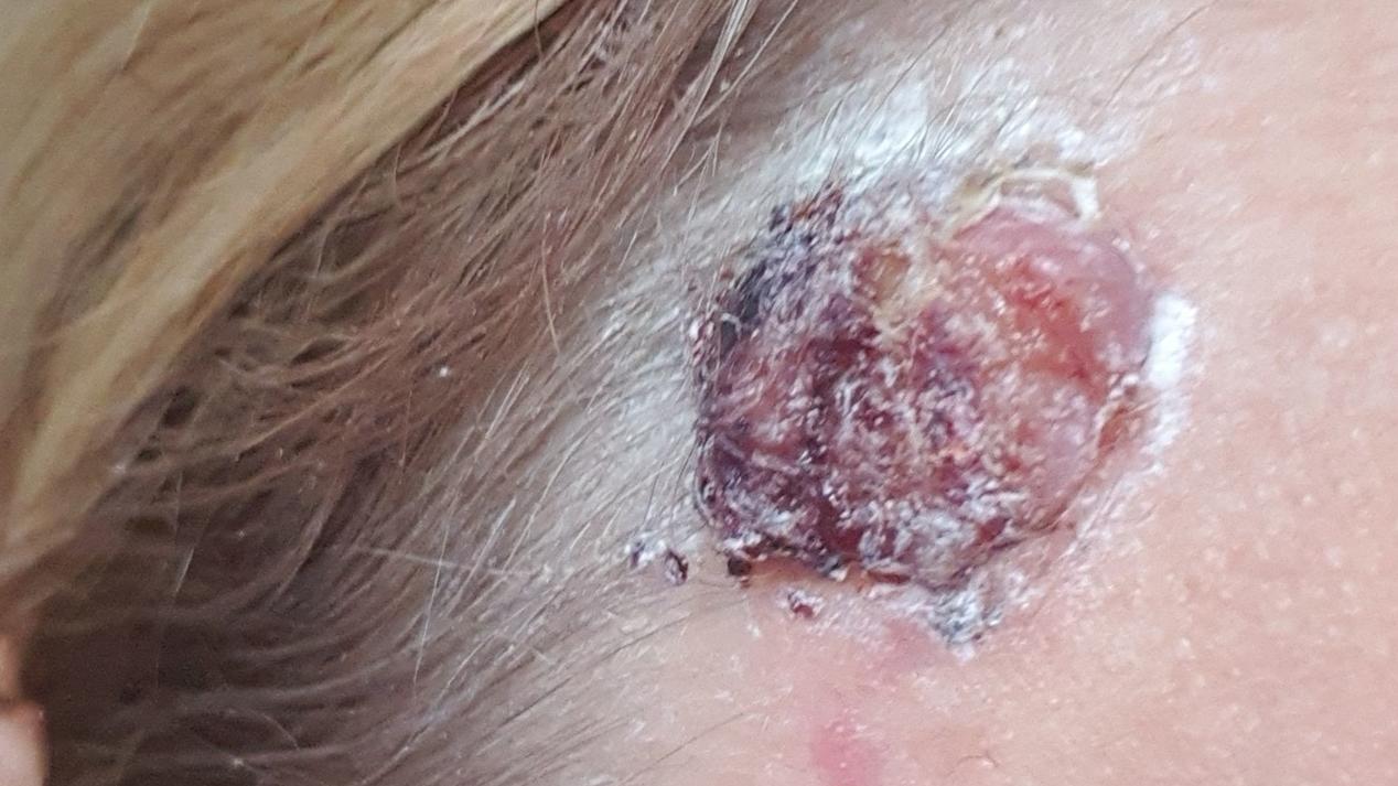 Frau läuft über Monate mit Hautkrebs ins Sonnenstudio Bösartiger Hautkrebstumor an der Stirn