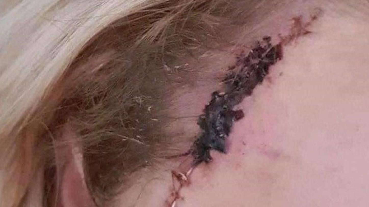 Frau läuft über Monate mit Hautkrebs ins Sonnenstudio Tumornarbe an der Stirn