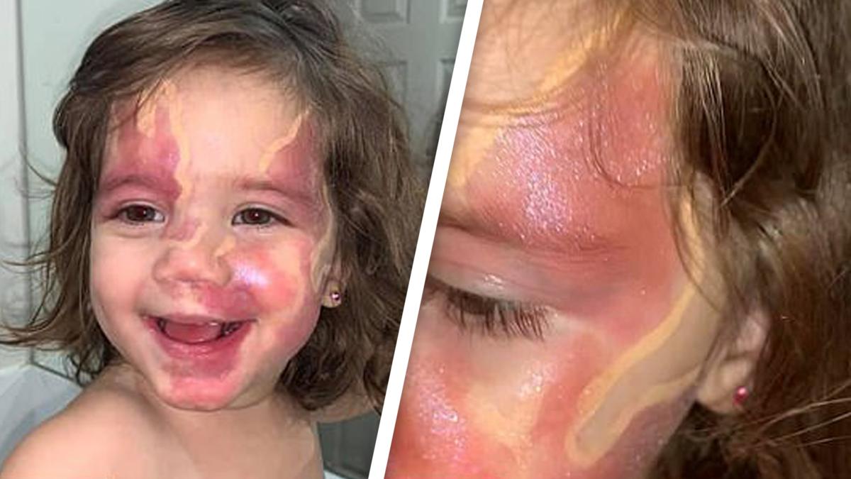 Angelica (1) soll sich niemals schämen Mutter lässt das Feuermal ihrer