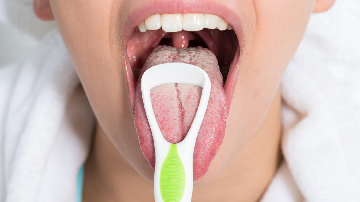 Weißlicher Zungenbelag ist ein Symptom für Mundsoor.
