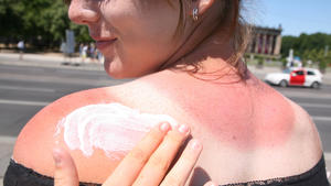 ARCHIV - 29.06.2011, Berlin: Eine Frau bekommt den Rücken mit Sonnencreme eingecremt. (zu dpa: «Listicle Frühlingswetter» vom 06.04.2018) Foto: Stephanie Pilick/dpa +++ dpa-Bildfunk +++